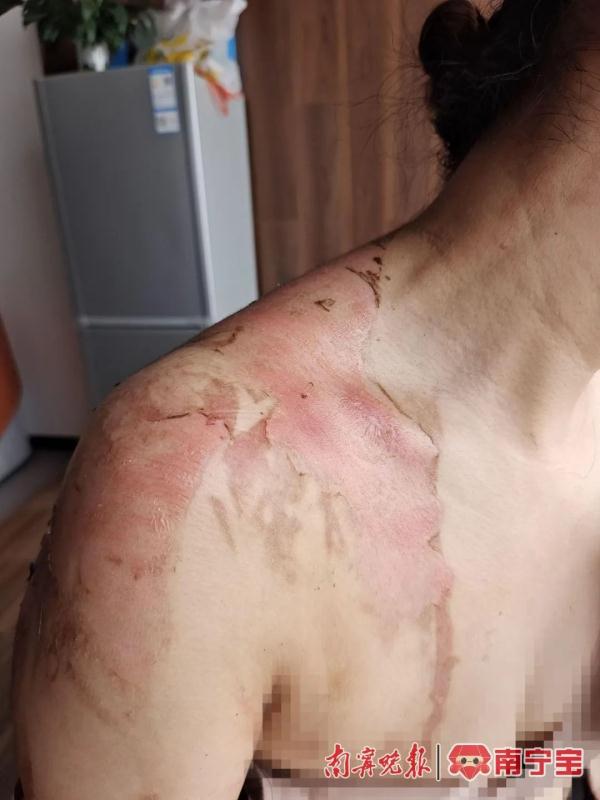 刚用几天的集成灶煲汤时突然“炸了”！南宁一女子被烧伤……